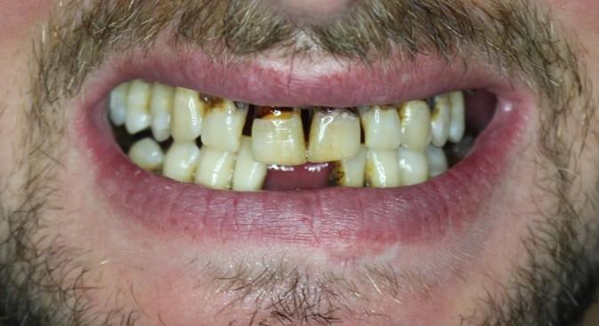 teeth needing repair
