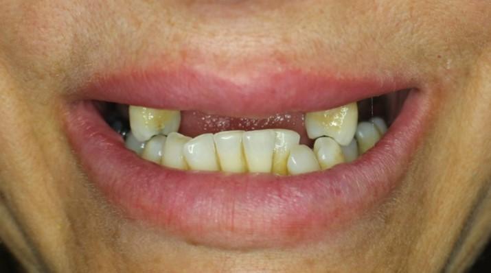 teeth needing repair