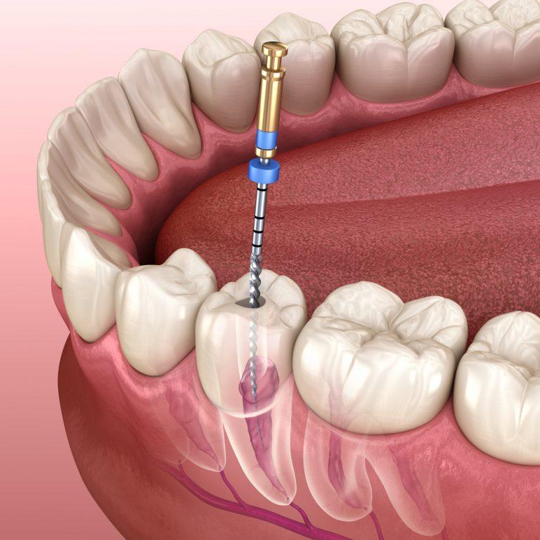 Endodontic Root Canal Treatment Process. Medically Accurate Tooth 3d Illustration.